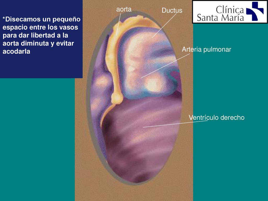 *Disecamos un pequeño espacio entre los vasos. para dar libertad a la. aorta diminuta y evitar. acodarla.