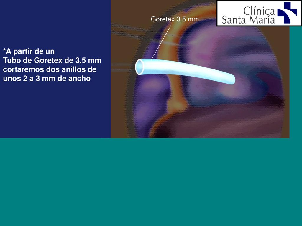 cortaremos dos anillos de unos 2 a 3 mm de ancho