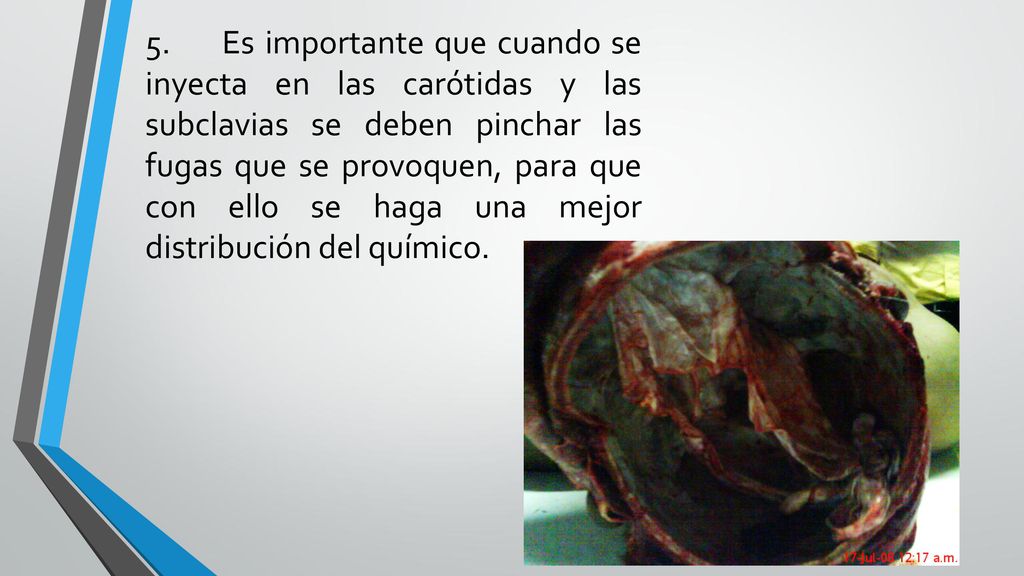 5. Es importante que cuando se inyecta en las carótidas y las subclavias se deben pinchar las fugas que se provoquen, para que con ello se haga una mejor distribución del químico.