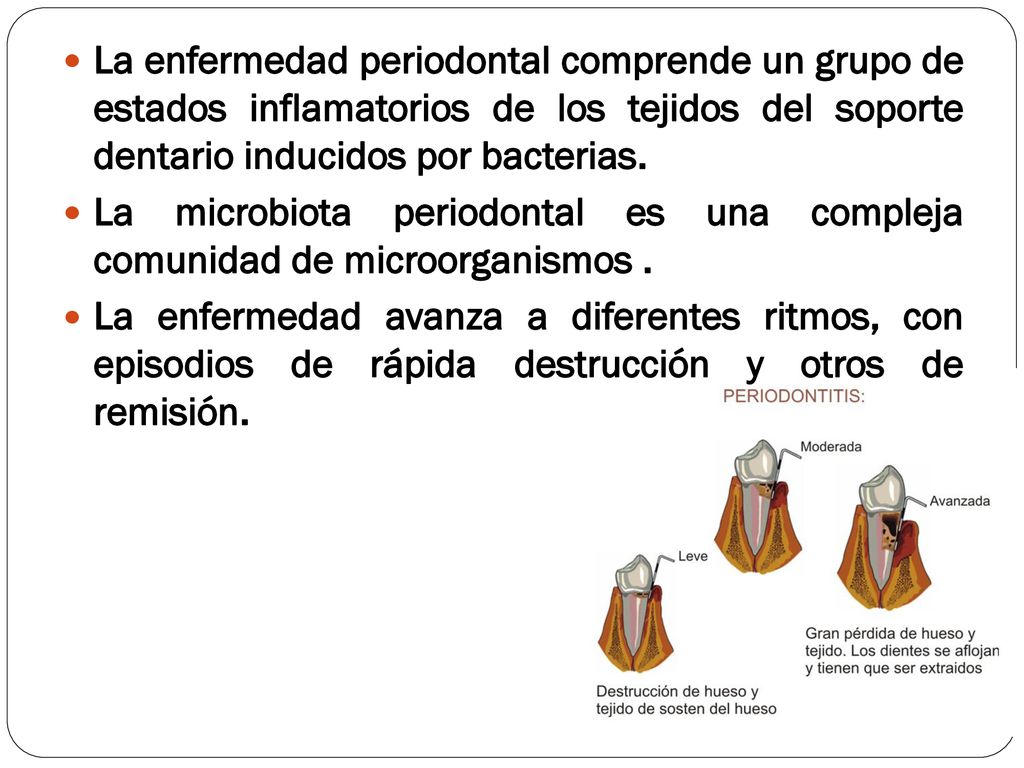 La enfermedad periodontal comprende un grupo de estados inflamatorios de los tejidos del soporte dentario inducidos por bacterias.