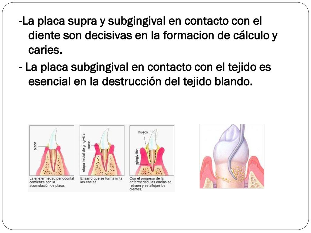 -La placa supra y subgingival en contacto con el diente son decisivas en la formacion de cálculo y caries.