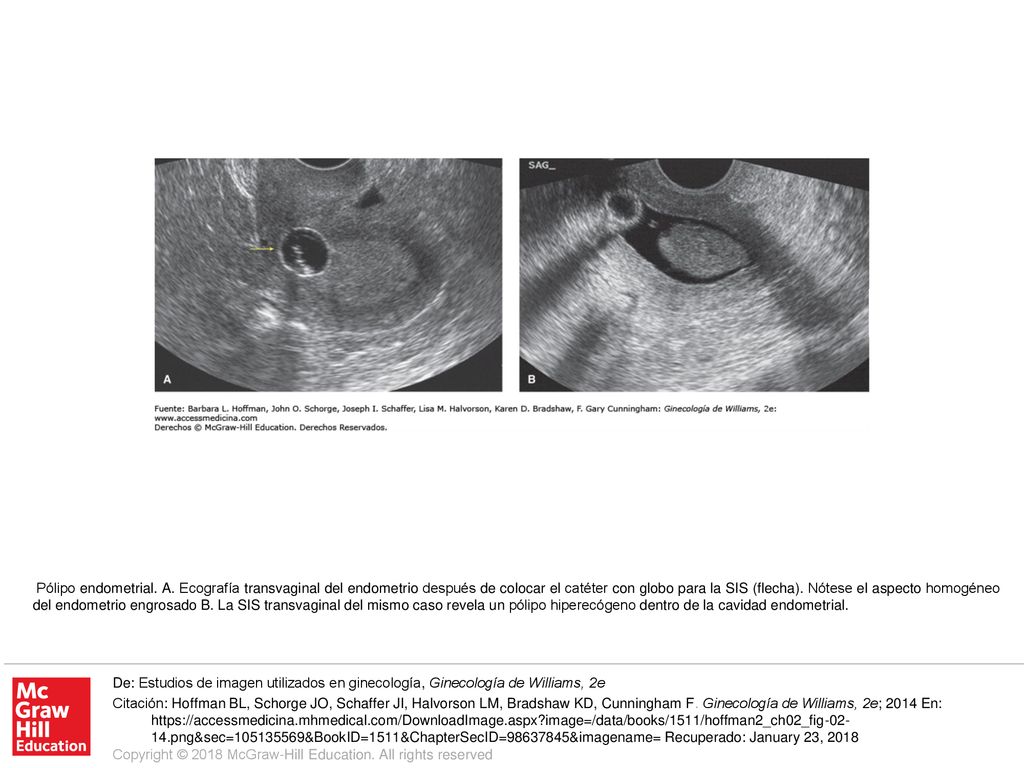 Pólipo endometrial. A. Ecografía transvaginal del endometrio después de colocar el catéter con globo para la SIS (flecha). Nótese el aspecto homogéneo del endometrio engrosado B. La SIS transvaginal del mismo caso revela un pólipo hiperecógeno dentro de la cavidad endometrial.