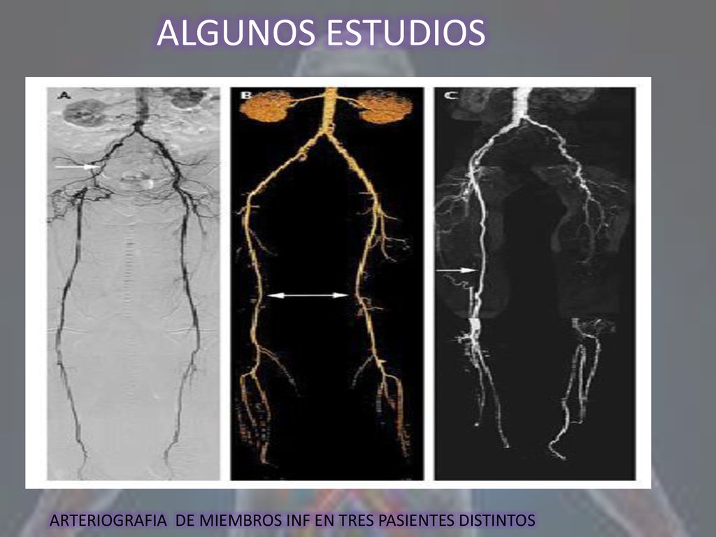 ALGUNOS ESTUDIOS ARTERIOGRAFIA DE MIEMBROS INF EN TRES PASIENTES DISTINTOS