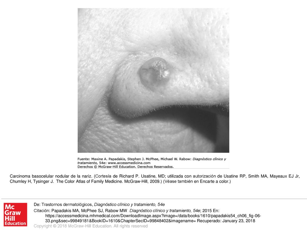 Carcinoma basocelular nodular de la nariz. (Cortesía de Richard P