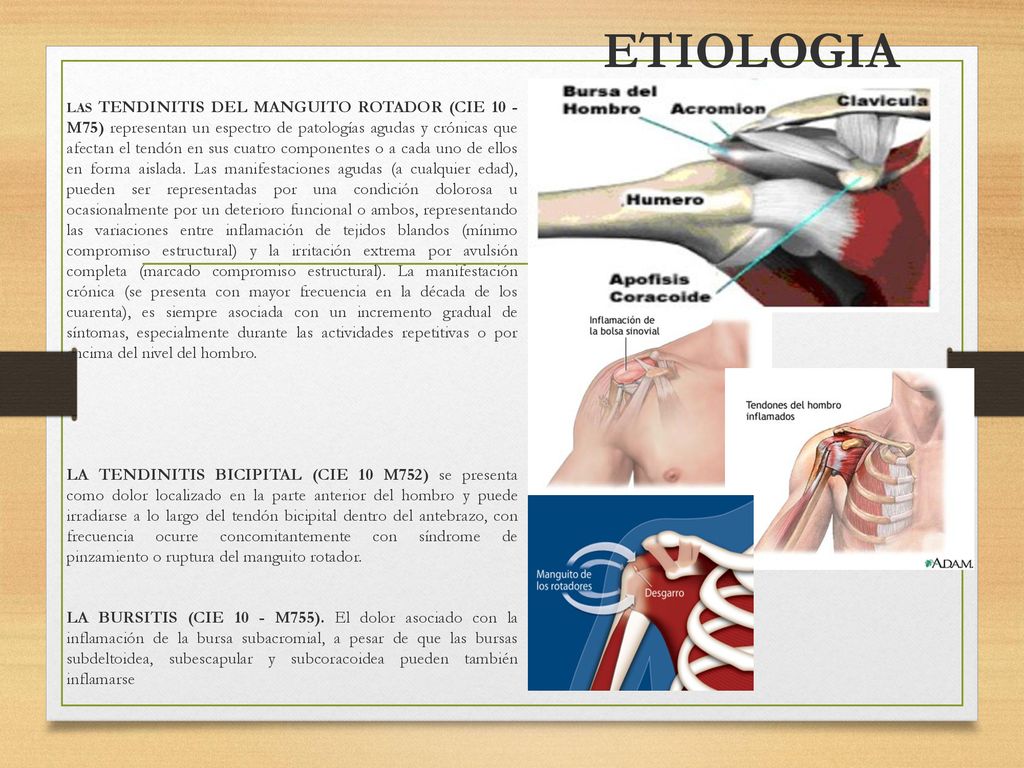 LAS TENDINITIS DEL MANGUITO ROTADOR (CIE 10 - M75) representan un espectro de patologías agudas y crónicas que afectan el tendón en sus cuatro componentes o a cada uno de ellos en forma aislada. Las manifestaciones agudas (a cualquier edad), pueden ser representadas por una condición dolorosa u ocasionalmente por un deterioro funcional o ambos, representando las variaciones entre inflamación de tejidos blandos (mínimo compromiso estructural) y la irritación extrema por avulsión completa (marcado compromiso estructural). La manifestación crónica (se presenta con mayor frecuencia en la década de los cuarenta), es siempre asociada con un incremento gradual de síntomas, especialmente durante las actividades repetitivas o por encima del nivel del hombro.