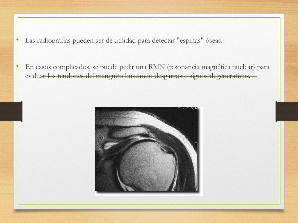 Las radiografías pueden ser de utilidad para detectar espinas óseas.