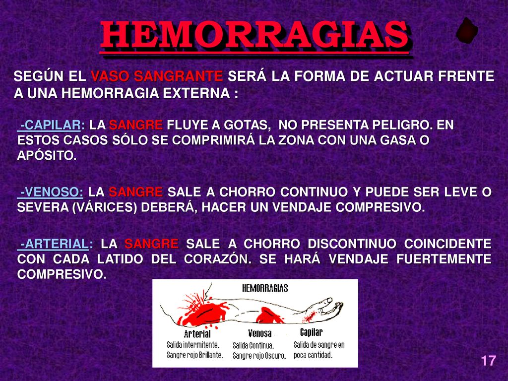 HEMORRAGIAS SEGÚN EL VASO SANGRANTE SERÁ LA FORMA DE ACTUAR FRENTE A UNA HEMORRAGIA EXTERNA :