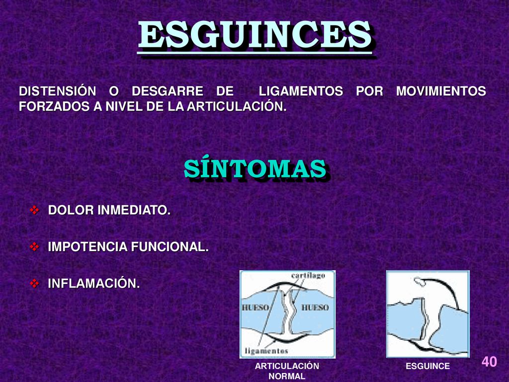 ESGUINCES DISTENSIÓN O DESGARRE DE LIGAMENTOS POR MOVIMIENTOS FORZADOS A NIVEL DE LA ARTICULACIÓN.
