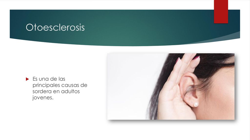 Otoesclerosis Es una de las principales causas de sordera en adultos jovenes.