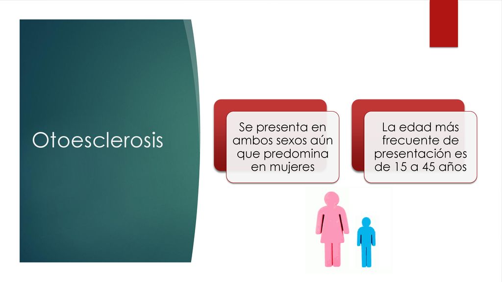 Otoesclerosis Se presenta en ambos sexos aún que predomina en mujeres