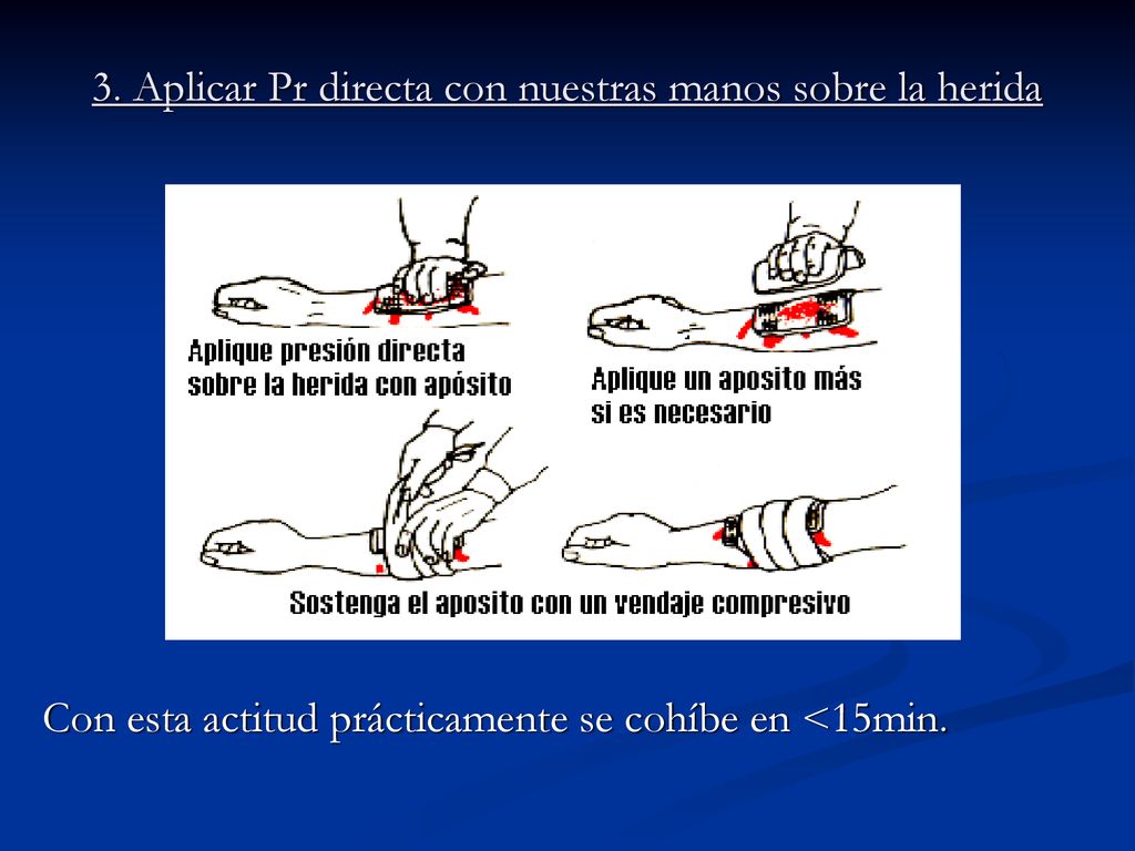 3. Aplicar Pr directa con nuestras manos sobre la herida