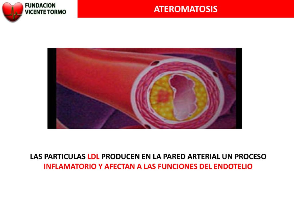 ATEROMATOSIS LAS PARTICULAS LDL PRODUCEN EN LA PARED ARTERIAL UN PROCESO INFLAMATORIO Y AFECTAN A LAS FUNCIONES DEL ENDOTELIO.