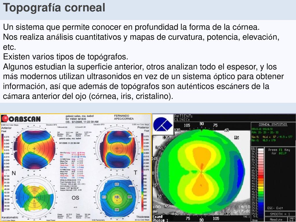 Topografía corneal Un sistema que permite conocer en profundidad la forma de la córnea.
