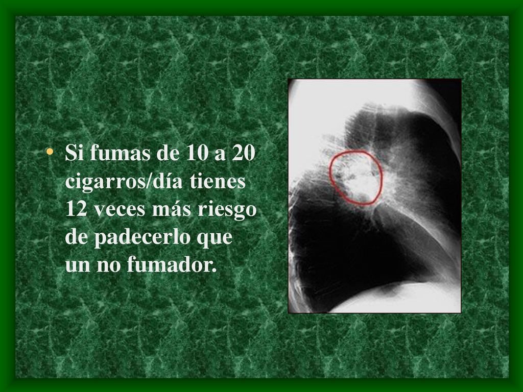 Si fumas de 10 a 20 cigarros/día tienes 12 veces más riesgo de padecerlo que un no fumador.