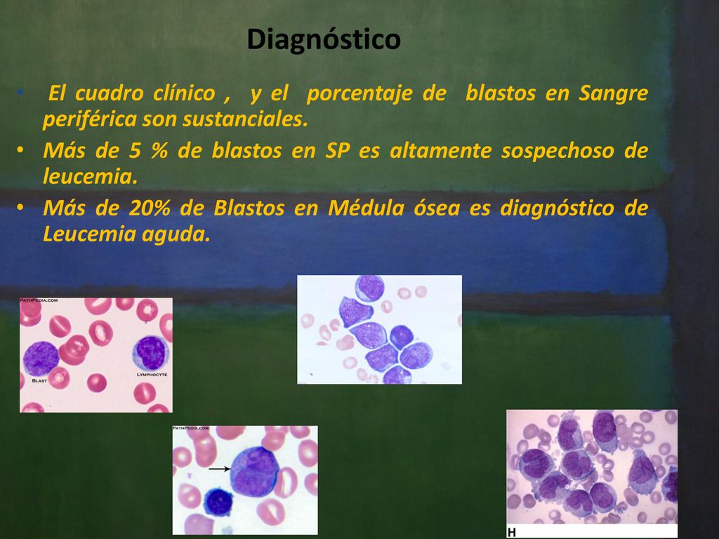 Diagnóstico El cuadro clínico , y el porcentaje de blastos en Sangre periférica son sustanciales.