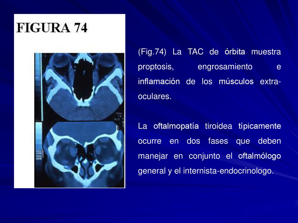 (Fig.74) La TAC de órbita muestra proptosis, engrosamiento e inflamación de los músculos extra-oculares.