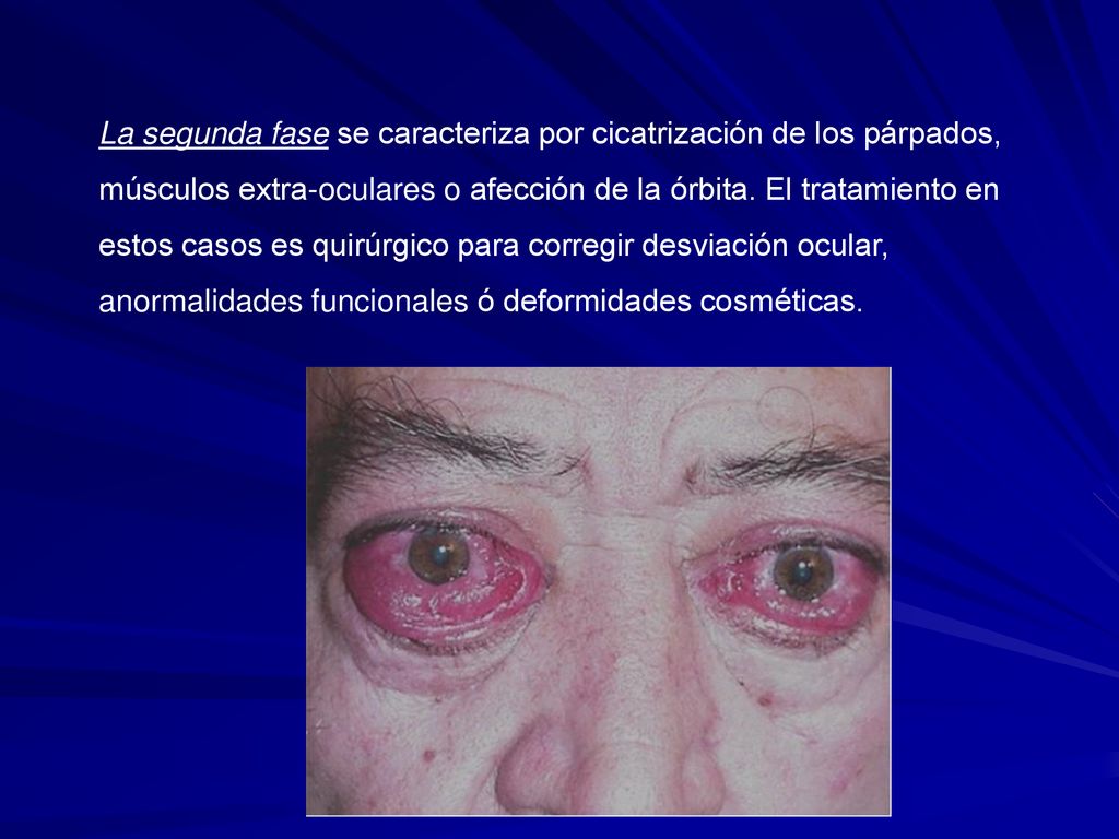 La segunda fase se caracteriza por cicatrización de los párpados, músculos extra-oculares o afección de la órbita.