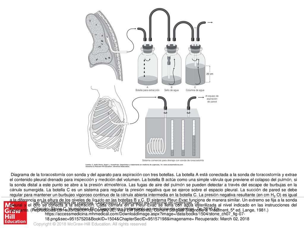 Diagrama de la toracostomía con sonda y del aparato para aspiración con tres botellas. La botella A está conectada a la sonda de toracostomía y extrae el contenido pleural drenado para inspección y medición del volumen. La botella B actúa como una simple válvula que previene el colapso del pulmón, si la sonda distal a este punto se abre a la presión atmosférica. Las fugas de aire del pulmón se pueden detectar a través del escape de burbujas en la cánula sumergida. La botella C es un sistema para regular la presión negativa que se ejerce sobre el espacio pleural. La succión de pared se debe regular para mantener un burbujeo vigoroso continuo de la cánula abierta intermedia en la botella C. La presión negativa resultante (en cm H2 O) es igual a la diferencia en la altura de los niveles de líquido en las botellas B y C. El sistema Pleur-Evac funciona de manera similar. Un extremo se fija a la sonda pleural y el otro se conecta a la aspiración. Cada cámara en el Pleur-Evac se llena con agua esterilizada al nivel indicado en las instrucciones del fabricante. (Reproducida con autorización de Dunphy JE, Way LW [editores]: Current Surgical Diagnosis & Treatment, 5ª ed. Lange, 1981.)