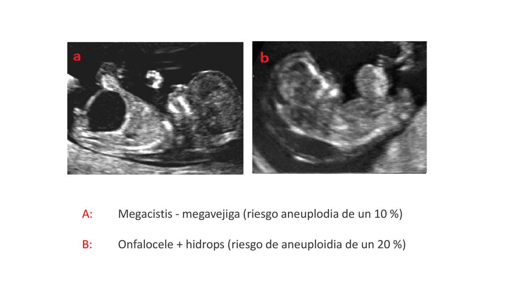 A: B: Megacistis - megavejiga (riesgo aneuplodia de un 10 %) Onfalocele + hidrops (riesgo de aneuploidia de un 20 %)