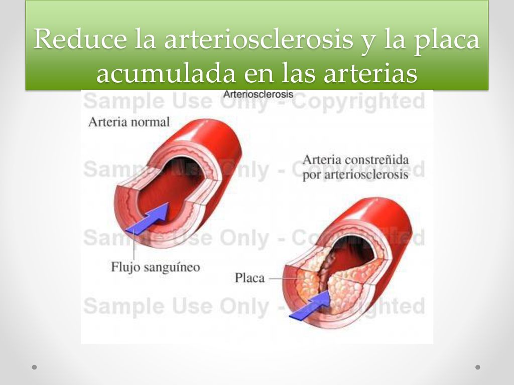 Reduce la arteriosclerosis y la placa acumulada en las arterias