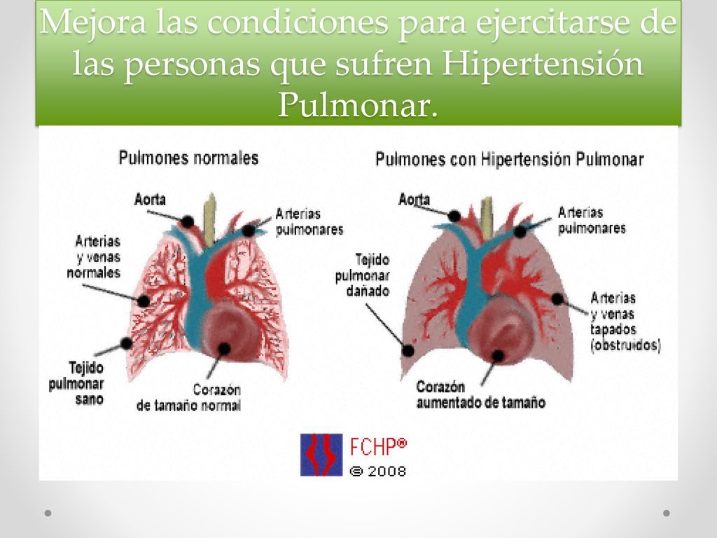 Mejora las condiciones para ejercitarse de las personas que sufren Hipertensión Pulmonar.