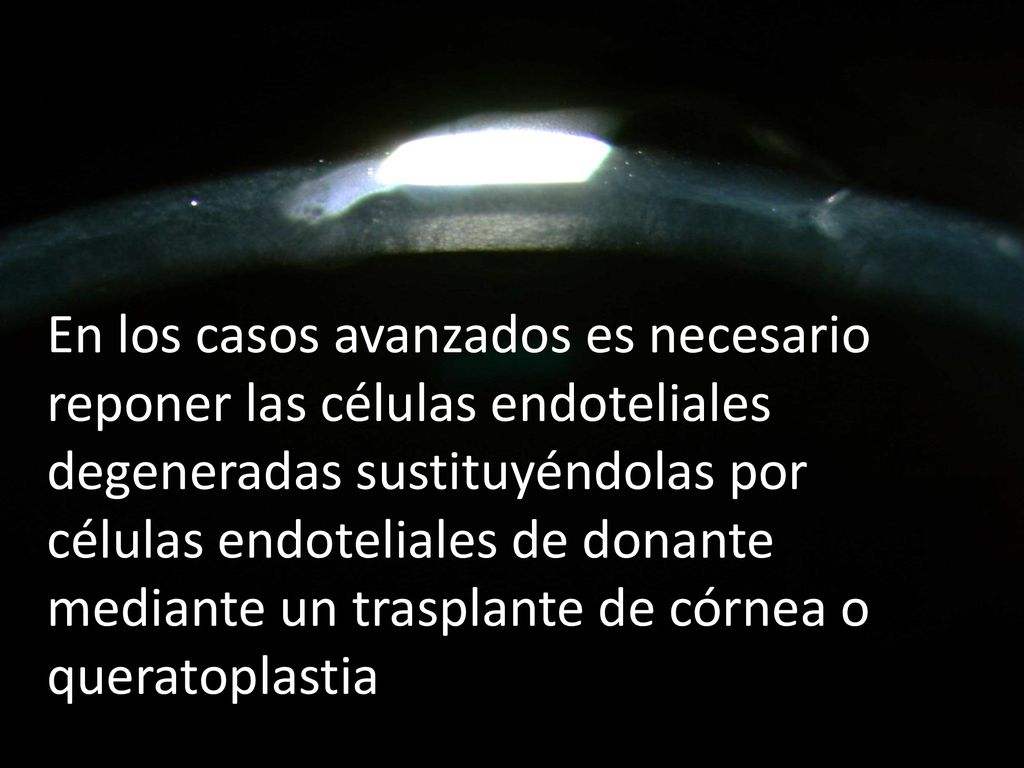 En los casos avanzados es necesario reponer las células endoteliales degeneradas sustituyéndolas por células endoteliales de donante mediante un trasplante de córnea o queratoplastia