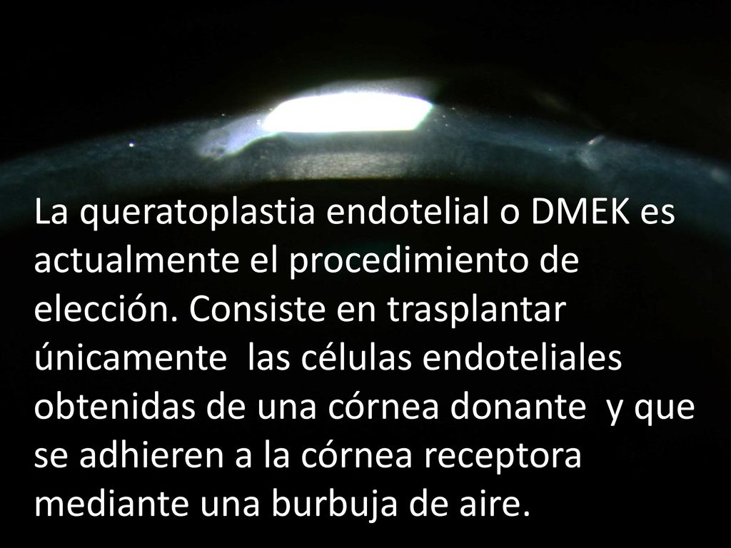 La queratoplastia endotelial o DMEK es actualmente el procedimiento de elección.