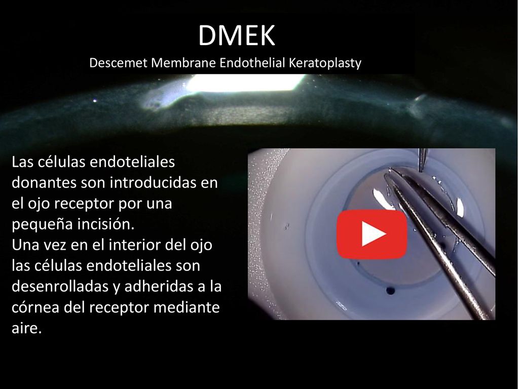 DMEK Descemet Membrane Endothelial Keratoplasty. Las células endoteliales donantes son introducidas en el ojo receptor por una pequeña incisión.