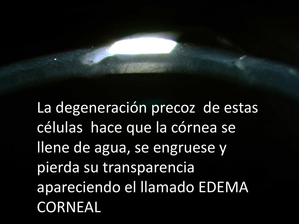 La degeneración precoz de estas células hace que la córnea se llene de agua, se engruese y pierda su transparencia apareciendo el llamado EDEMA CORNEAL