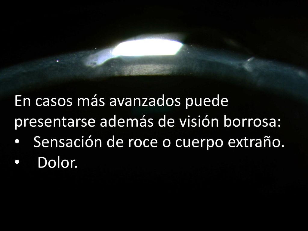 En casos más avanzados puede presentarse además de visión borrosa: