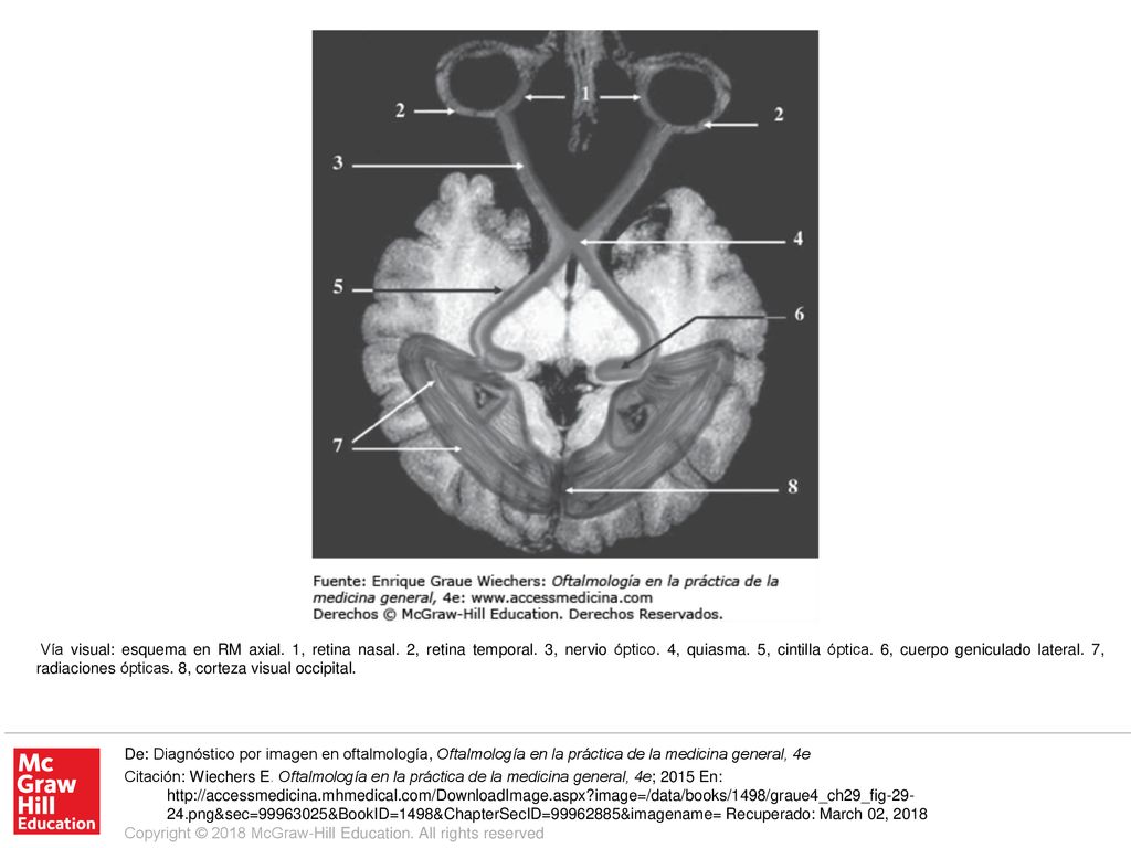 Vía visual: esquema en RM axial. 1, retina nasal. 2, retina temporal