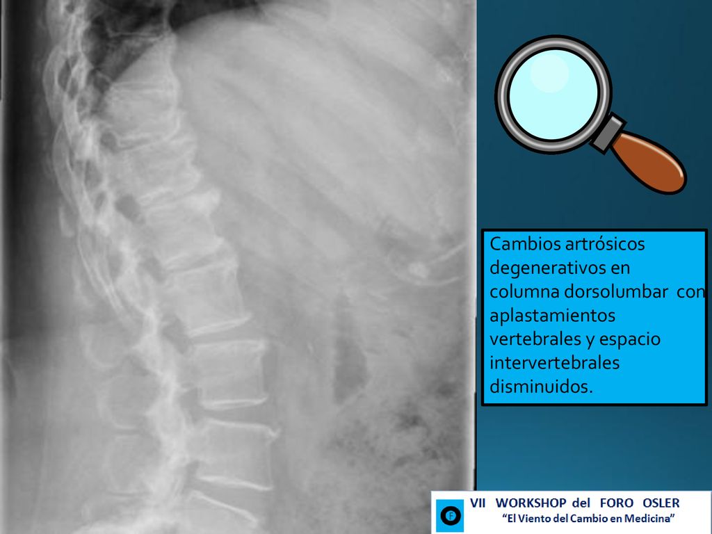 Cambios artrósicos degenerativos en columna dorsolumbar con aplastamientos vertebrales y espacio intervertebrales disminuidos.