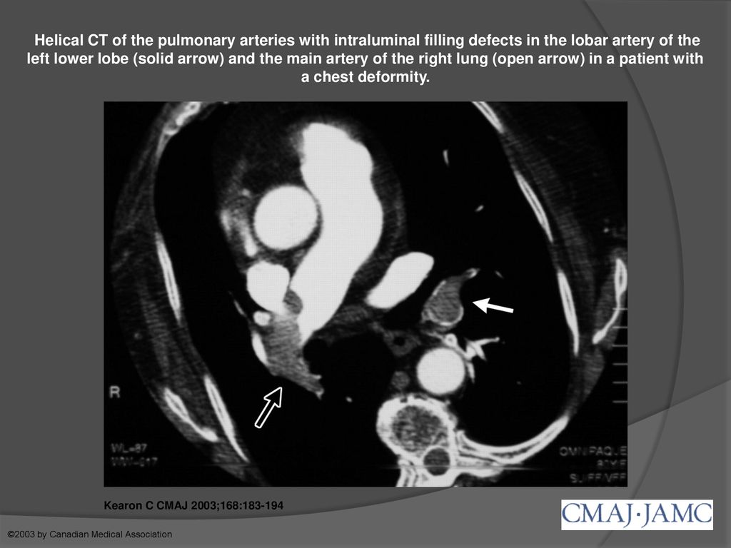 Helical CT of the pulmonary arteries with intraluminal filling defects in the lobar artery of the left lower lobe (solid arrow) and the main artery of the right lung (open arrow) in a patient with a chest deformity.
