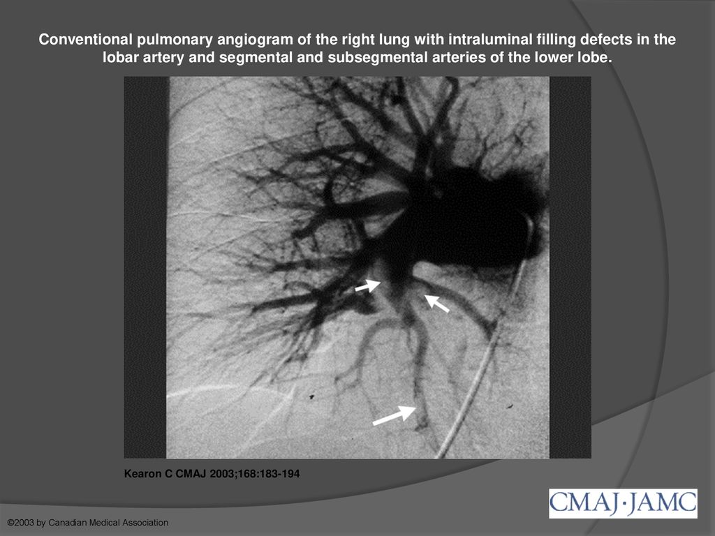 Conventional pulmonary angiogram of the right lung with intraluminal filling defects in the lobar artery and segmental and subsegmental arteries of the lower lobe.