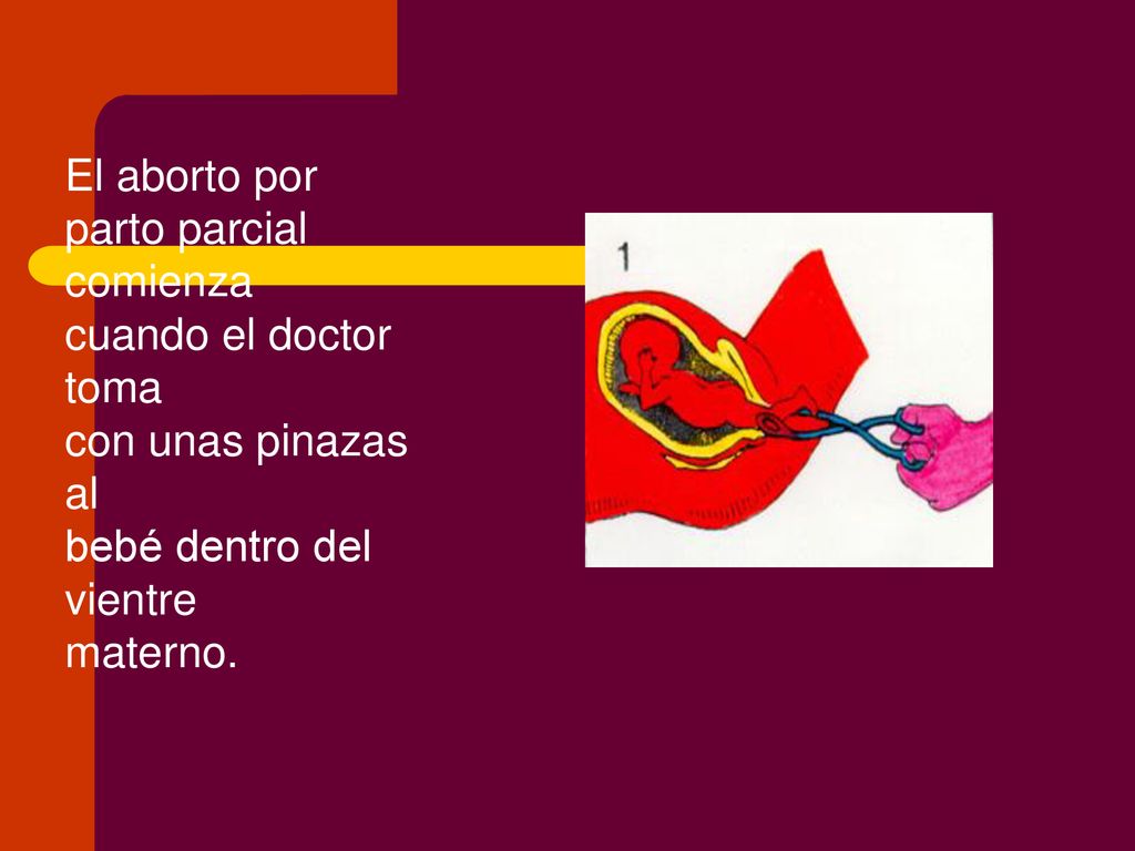 El aborto por parto parcial comienza cuando el doctor toma con unas pinazas al bebé dentro del vientre materno.