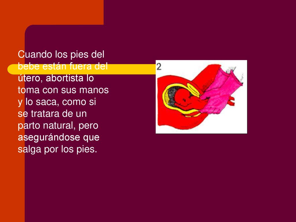 Cuando los pies del bebe están fuera del útero, abortista lo toma con sus manos y lo saca, como si se tratara de un parto natural, pero asegurándose que salga por los pies.