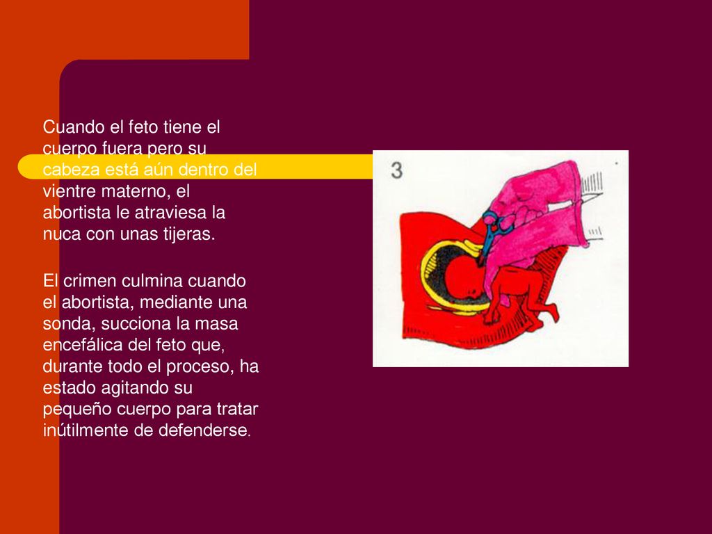 Cuando el feto tiene el cuerpo fuera pero su cabeza está aún dentro del vientre materno, el abortista le atraviesa la nuca con unas tijeras.