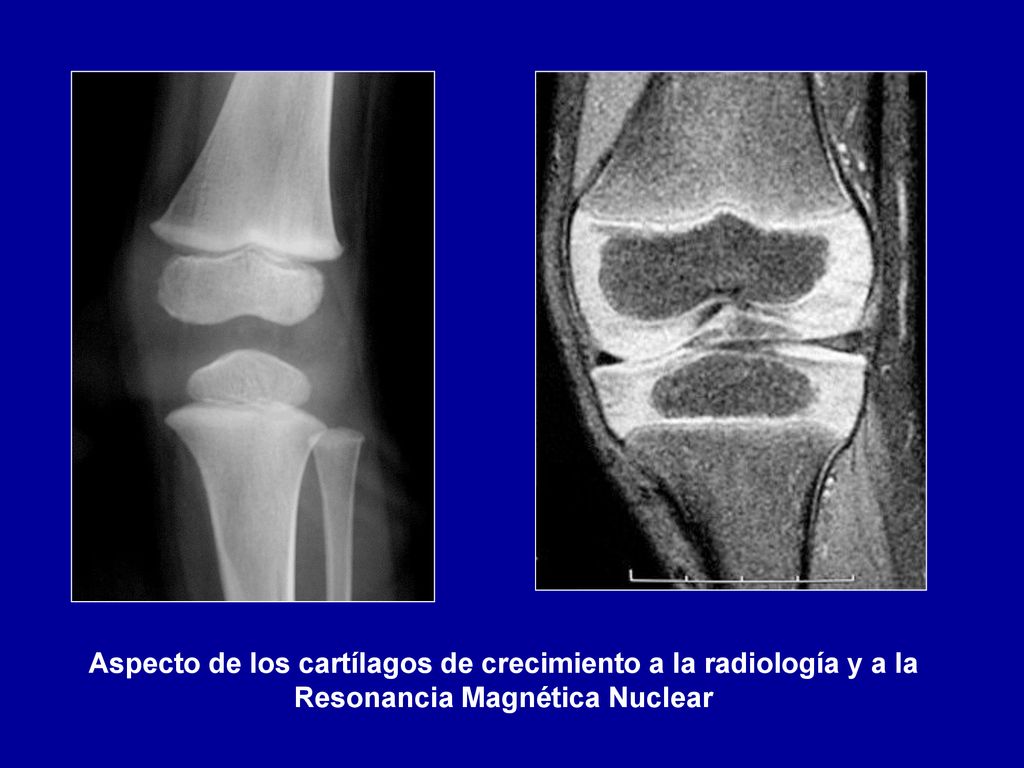 Aspecto de los cartílagos de crecimiento a la radiología y a la Resonancia Magnética Nuclear