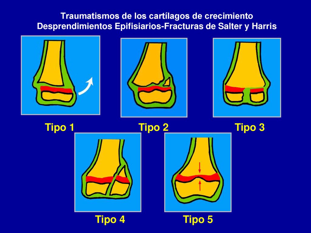 Tipo 1 Tipo 2 Tipo 3 Tipo 4 Tipo 5