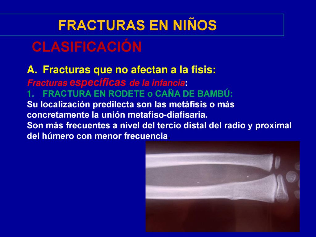 FRACTURAS EN NIÑOS CLASIFICACIÓN Fracturas que no afectan a la fisis: