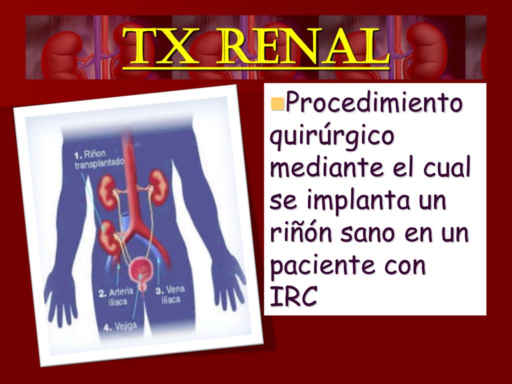TX RENAL Procedimiento quirúrgico mediante el cual se implanta un riñón sano en un paciente con IRC