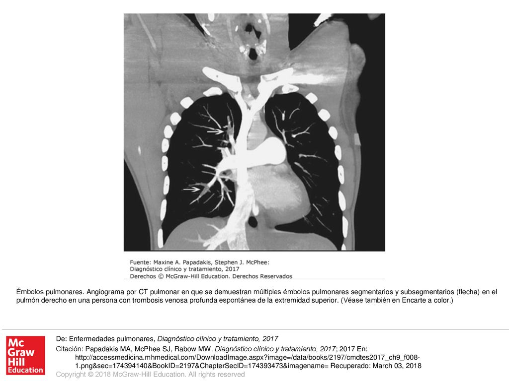 Émbolos pulmonares. Angiograma por CT pulmonar en que se demuestran múltiples émbolos pulmonares segmentarios y subsegmentarios (flecha) en el pulmón derecho en una persona con trombosis venosa profunda espontánea de la extremidad superior. (Véase también en Encarte a color.)