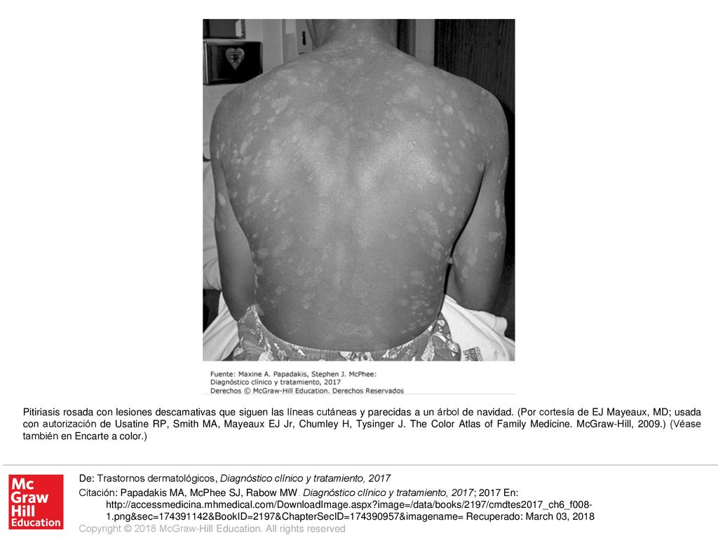 Pitiriasis rosada con lesiones descamativas que siguen las líneas cutáneas y parecidas a un árbol de navidad. (Por cortesía de EJ Mayeaux, MD; usada con autorización de Usatine RP, Smith MA, Mayeaux EJ Jr, Chumley H, Tysinger J. The Color Atlas of Family Medicine. McGraw-Hill, 2009.) (Véase también en Encarte a color.)