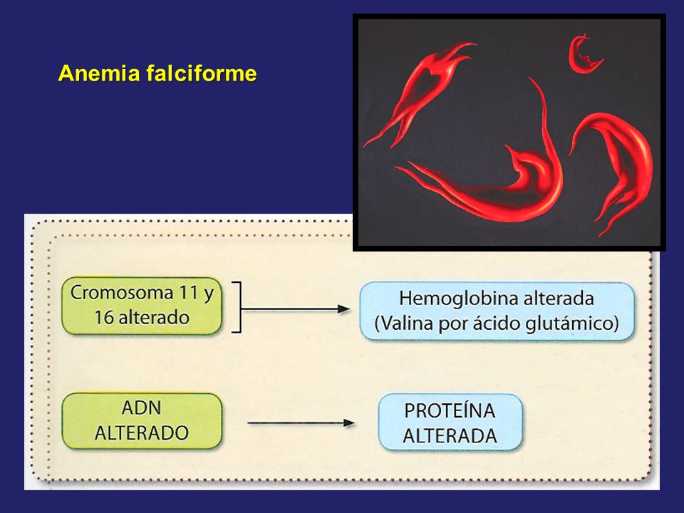 Anemia falciforme