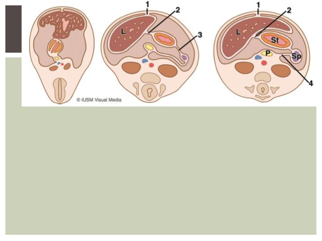 Illustrations show the embryologic development of the dorsal and ventral mesentery at weeks 4 (left), 5 (center), and 6 (right) of gestation, in which the ventral part of the ventral mesentery becomes the falciform ligament (1), the dorsal part of the ventral mesentery becomes the lesser omentum (2), the ventral part of the dorsal mesentery becomes the gastrosplenic ligament (3), and the dorsal part of the dorsal mesentery becomes the splenorenal ligament (4).The liver (L) also arises in the ventral mesentery, whereas the stomach (St), spleen (Sp), and pancreatic tail (P) develop in the dorsal mesentery.