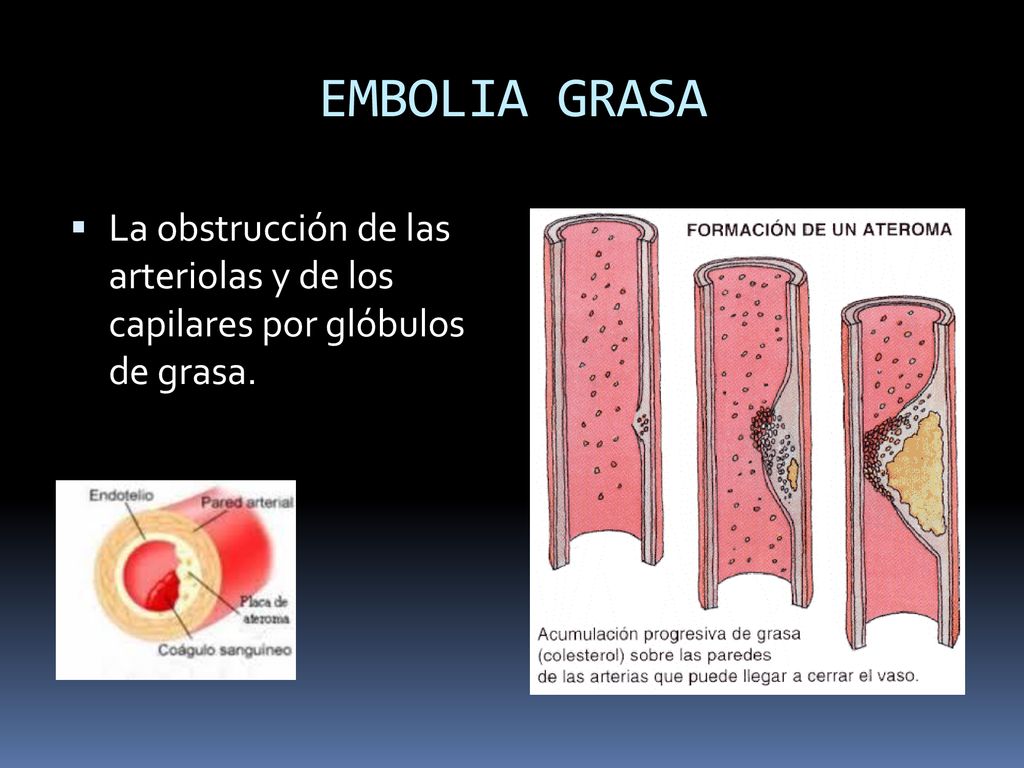 EMBOLIA GRASA La obstrucción de las arteriolas y de los capilares por glóbulos de grasa.