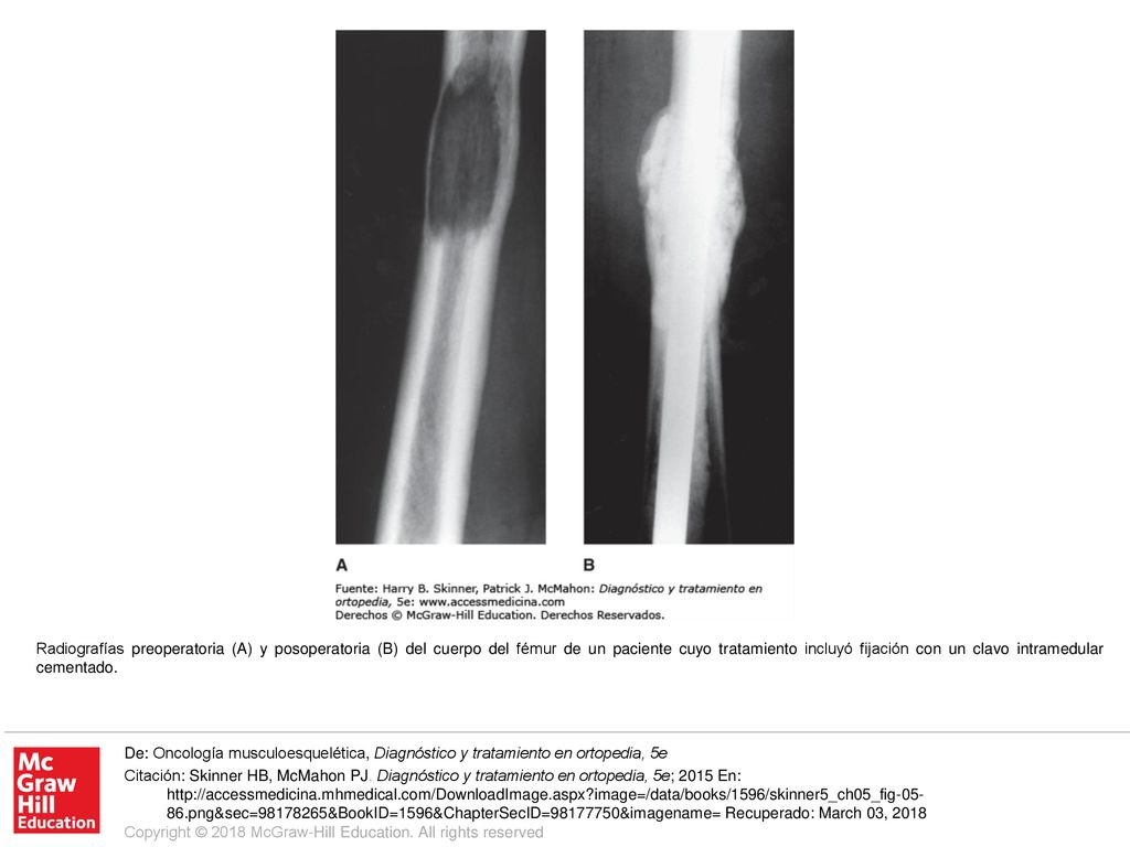 Radiografías preoperatoria (A) y posoperatoria (B) del cuerpo del fémur de un paciente cuyo tratamiento incluyó fijación con un clavo intramedular cementado.