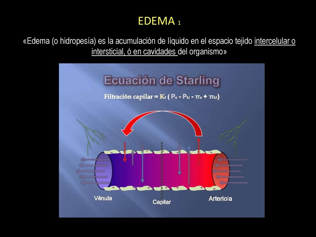 EDEMA 1 «Edema (o hidropesía) es la acumulación de líquido en el espacio tejido intercelular o intersticial, ó en cavidades del organismo»