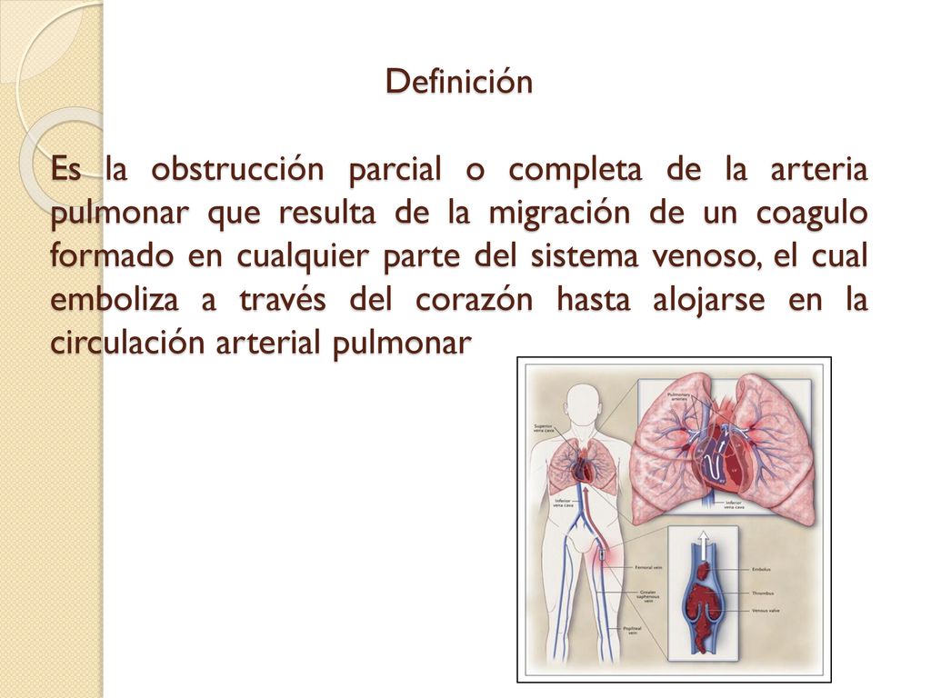 Tromboembolia Pulmonar Ppt Descargar