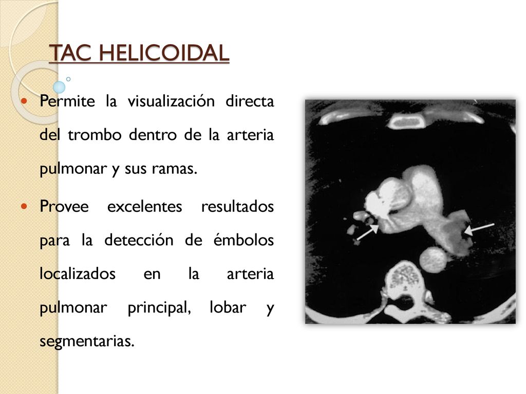 TAC HELICOIDAL Permite la visualización directa del trombo dentro de la arteria pulmonar y sus ramas.